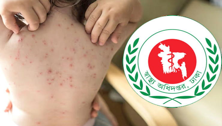 হামের আতঙ্কে দেশ, উপসর্গ নিয়ে আরও ১১ শিশুর মৃত্যু